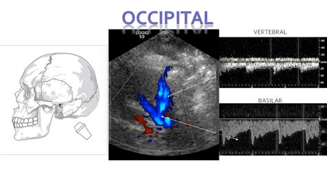 Transcranial Doppler | Ultrasound, Medical ultrasound, Vascular ultrasound