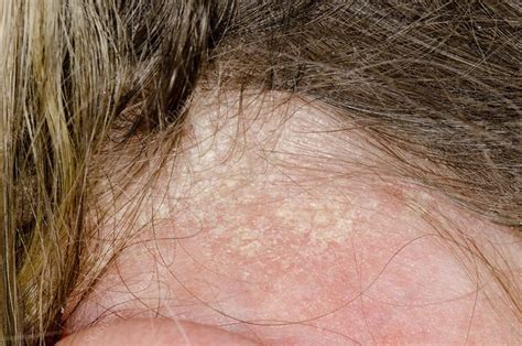 Psoriasis of the scalp - Stock Image - C013/0975 - Science Photo Library