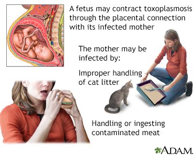 Toxoplasmosis Information | Mount Sinai - New York