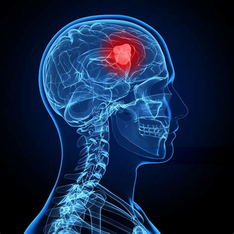 Brain tumor symptoms and causes - HealthZigZag