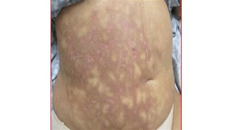 Mottled Skin (Livedo Reticularis): Causes, Signs, and Treatment