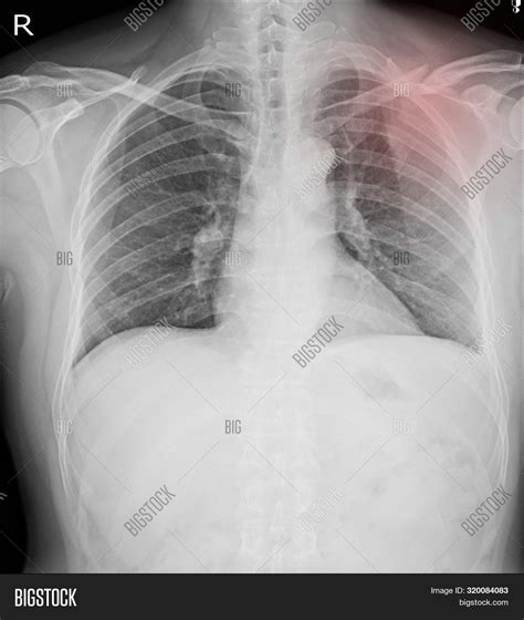 Chest X-ray Fractures Image & Photo (Free Trial) | Bigstock