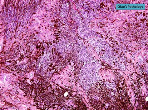 Blue Nevus Histology