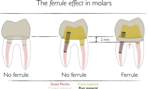 What is Ferrule in Dentistry? | News | Dentagama