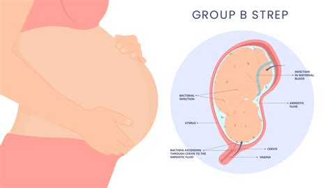 Everything you need to know about Group B Strep (GBS)