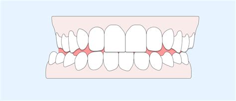 Crossbite: Causes, Symptoms, and Treatment | Caspersmile Aligners