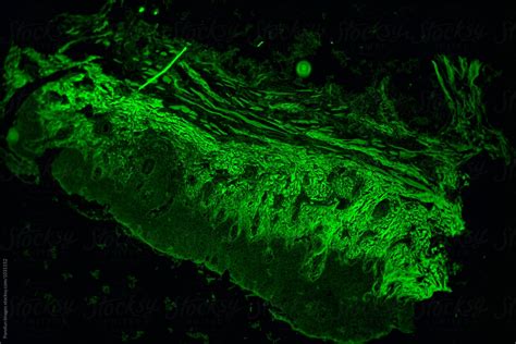 "Human Cancer Cells Of Meibomian Gland Tissue Tumour" by Stocksy Contributor "Pansfun Images ...