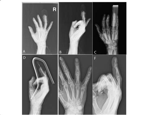 Male patient, 40 years old with crush injury and tuft fracture of the ...