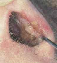 Malignant Nasal Tumors - Hearing Loss - Mussen Healthcare