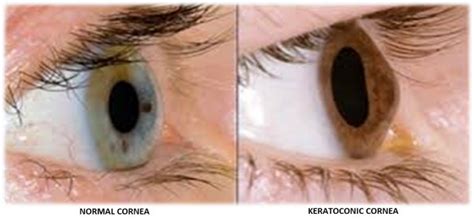 Keratoconus Eye Treatment & Eye Surgery - Keratoconus Diagnosis