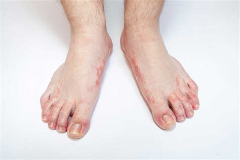 Cure Your Athlete’s Foot with Time-Honored Remedies | The People's Pharmacy