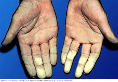 Raynaud's disease - Symptoms and causes - Mayo Clinic