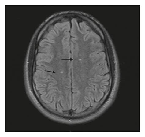 (a) There are few small foci of T2 and FLAIR hyperintensity noted in... | Download Scientific ...