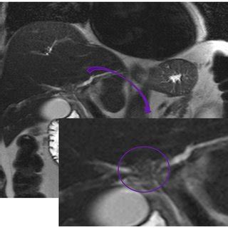 MRI 3D reconstruction of the biliary tree showing central hilar filling... | Download Scientific ...