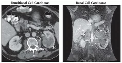 DA15-DB1-Delayed_or_Persistent_Nephrogram-FFU3.gif | Abdominal Key