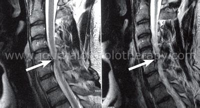 Non-Operative Treatment of Cervical Radiculopathy: A Three Part Article ...