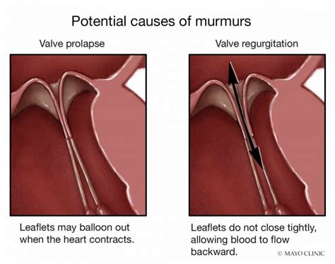 What do you know about heart murmurs? - Mayo Clinic News Network