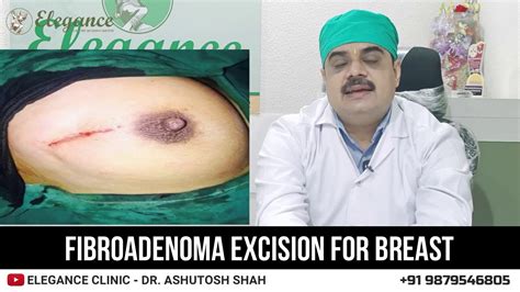 Fibroadenoma Excision For Breast Surgery By Dr. Ashutosh Shah, Surat ...