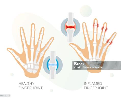 Inflammation Finger Joint Pain As Stock Illustration Stock Illustration ...