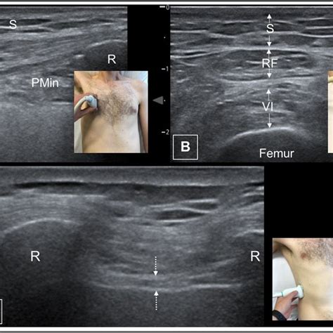 Echogenicity of parasternal intercostal muscle. Typical ultrasound... | Download Scientific Diagram