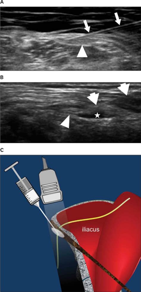 Lateral Meralgia Paresthetica