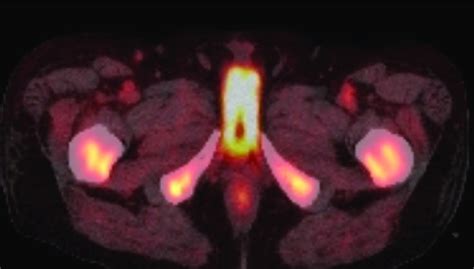 PET scan demonstrating the bilateral extension of prostatic tumor into ...