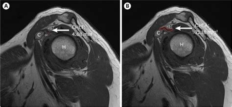 Optimal Cut-Off Value of the Coracohumeral Ligament Area as a Morphological Parameter to Confirm ...