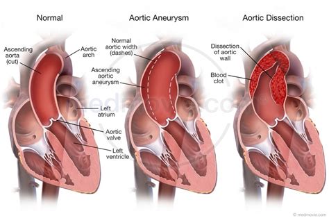 Image Gallery Dissection Aortic