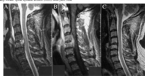 Figure 1 from Successful treatment of cervical spinal epidural abscess without surgery ...