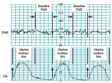 Cardiotocography; CTG, Antepartum