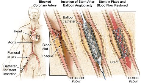 Stents to Treat Coronary Artery Blockages | Cardiology | JAMA | The ...