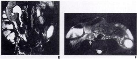 year-old man with lymphomatous infiltration of right ureter. A, CT scan ...