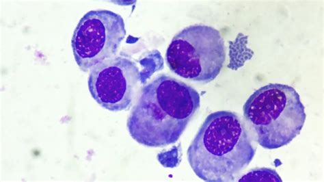 Transitional epithelial cells in urine cytology - YouTube