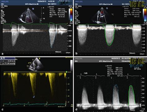 Echocardiographic Evaluation of Aortic Stenosis | Radiology Key