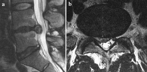 a, b A case of disc extrusion visible on MRI T2w sequences in sagittal ...