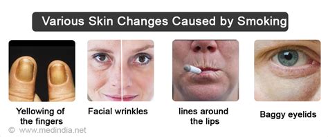 Smoking and its Effect on Skin