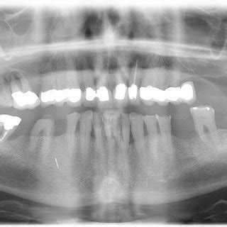 Orthopantomogram taken in October 2019. | Download Scientific Diagram
