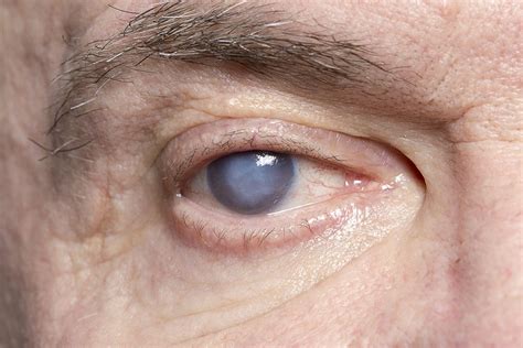 Cataract Symptoms - Monterey, CA - Monterey County Eye Associates