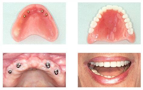 Denture Implants Sydney | Denture Care Clinic