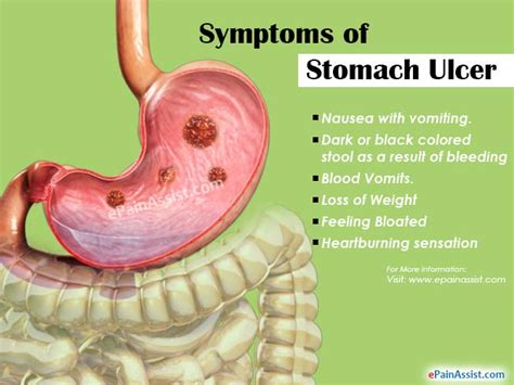 The meaning and symbolism of the word - «Ulcer (stomach)»