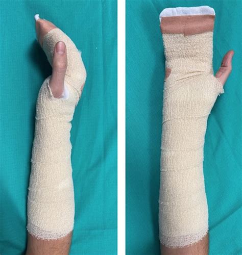 New modified rehabilitation regime for internally fixed metacarpal fractures | dr Sonja Cerovac