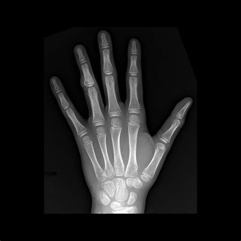 Salter-Harris Fracture | Pediatric Radiology Reference Article ...