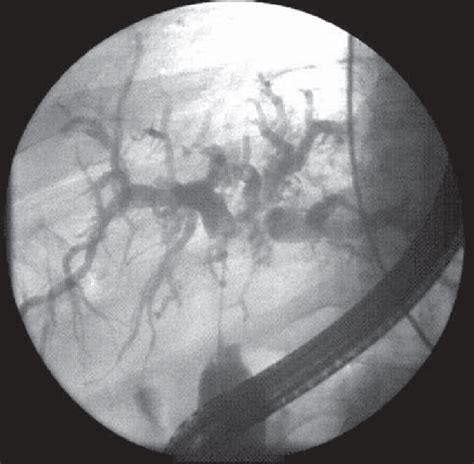 Endoscopic retrograde cholangiopancreatography image from the same... | Download Scientific Diagram