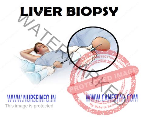 LIVER BIOPSY - Nurse Info