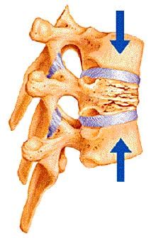 Thoracic Compression Fractures | University of Maryland Medical Center