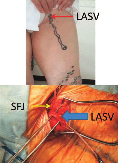 Case 1. A 64-year-old female underwent high ligation and greater ...