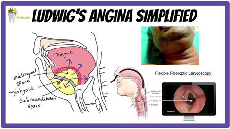 ORAL SURGERY | LUDWIG'S ANGINA SIMPLIFIED - YouTube