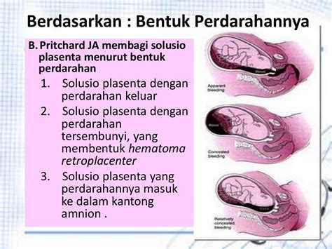 Solusio Plasenta