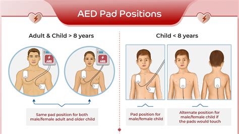 funest Poate Obraznic aed pad placement secol Bebelus alege