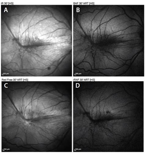 Epiretinal Membrane Surgery Recovery